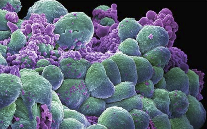 fungus cancer