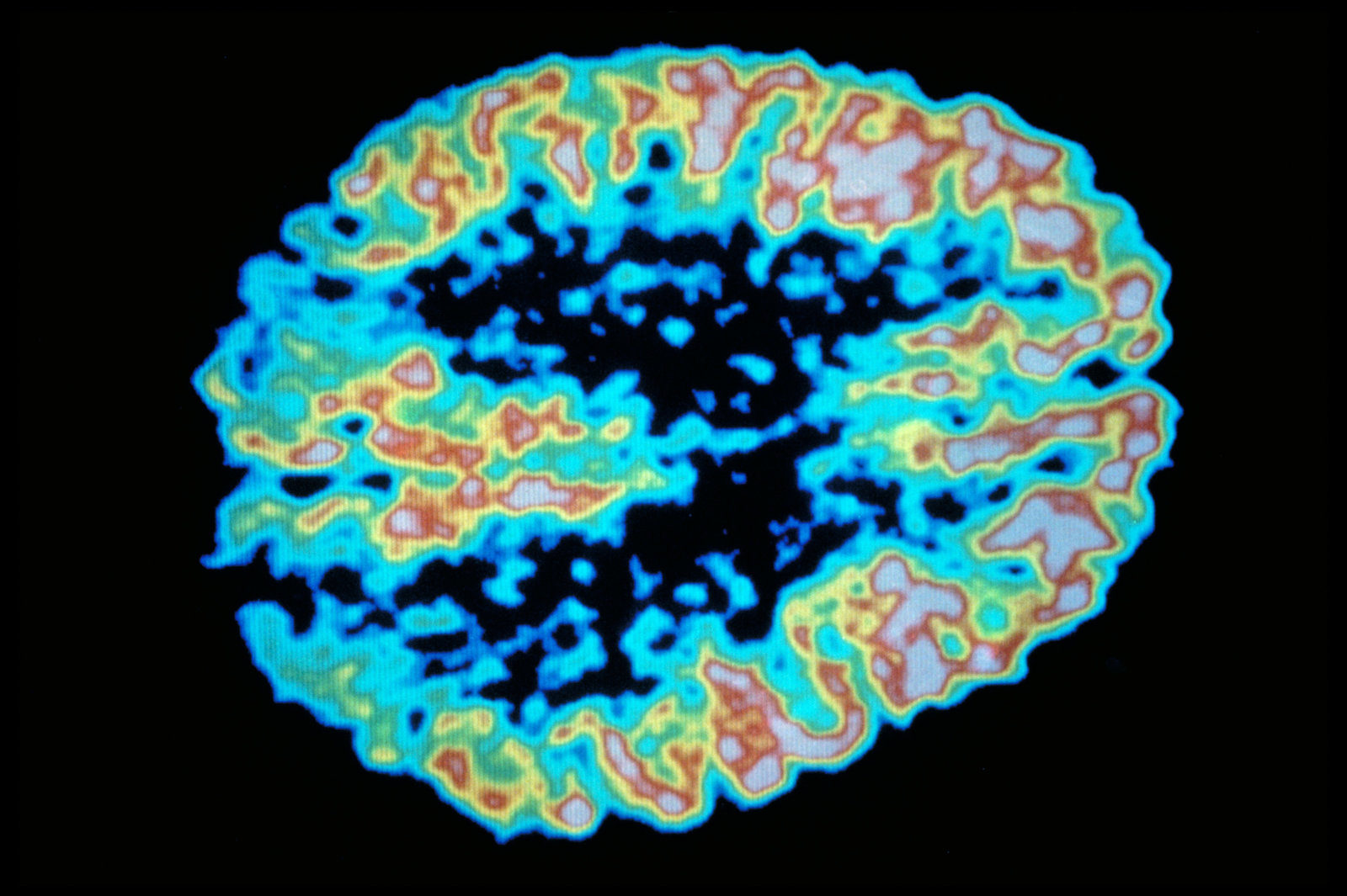 PET scan sugar brain