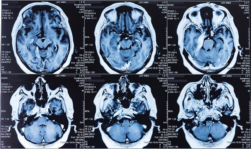 MRI Brain Scans