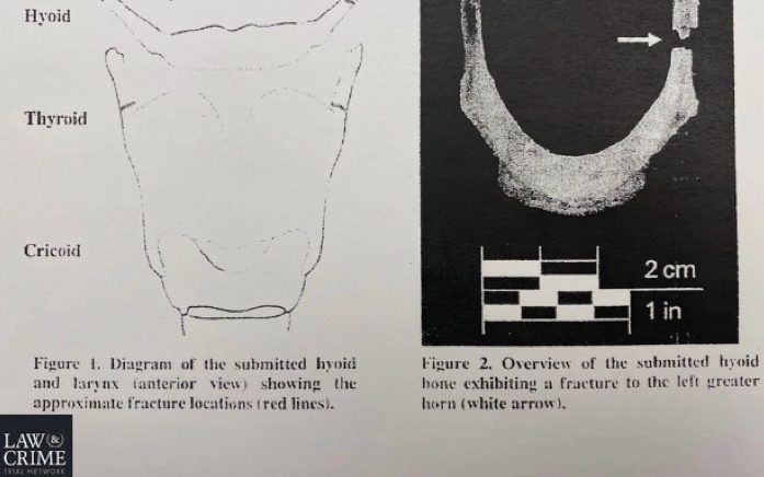 Click to enlarge Epstein fractures