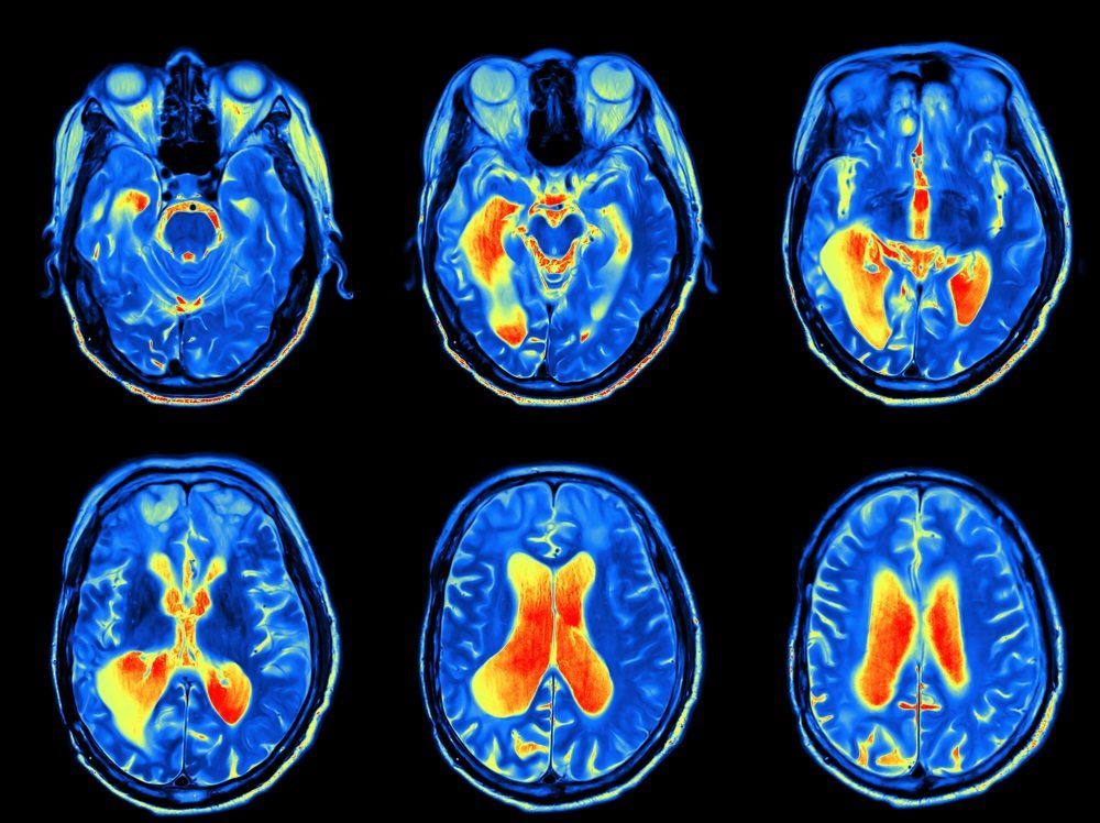 MRI scan of the brain