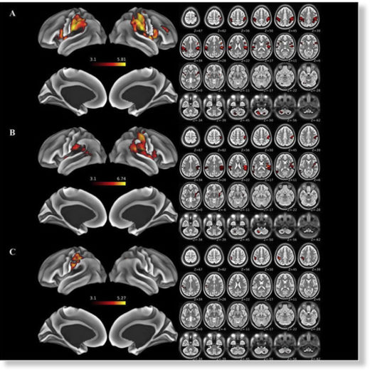 Click to enlarge brain injury MRI