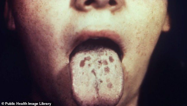 Syphilis ulcers on the tongue