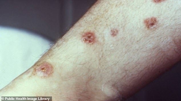 Click to enlarge Syphilis lesions on the patients ankle