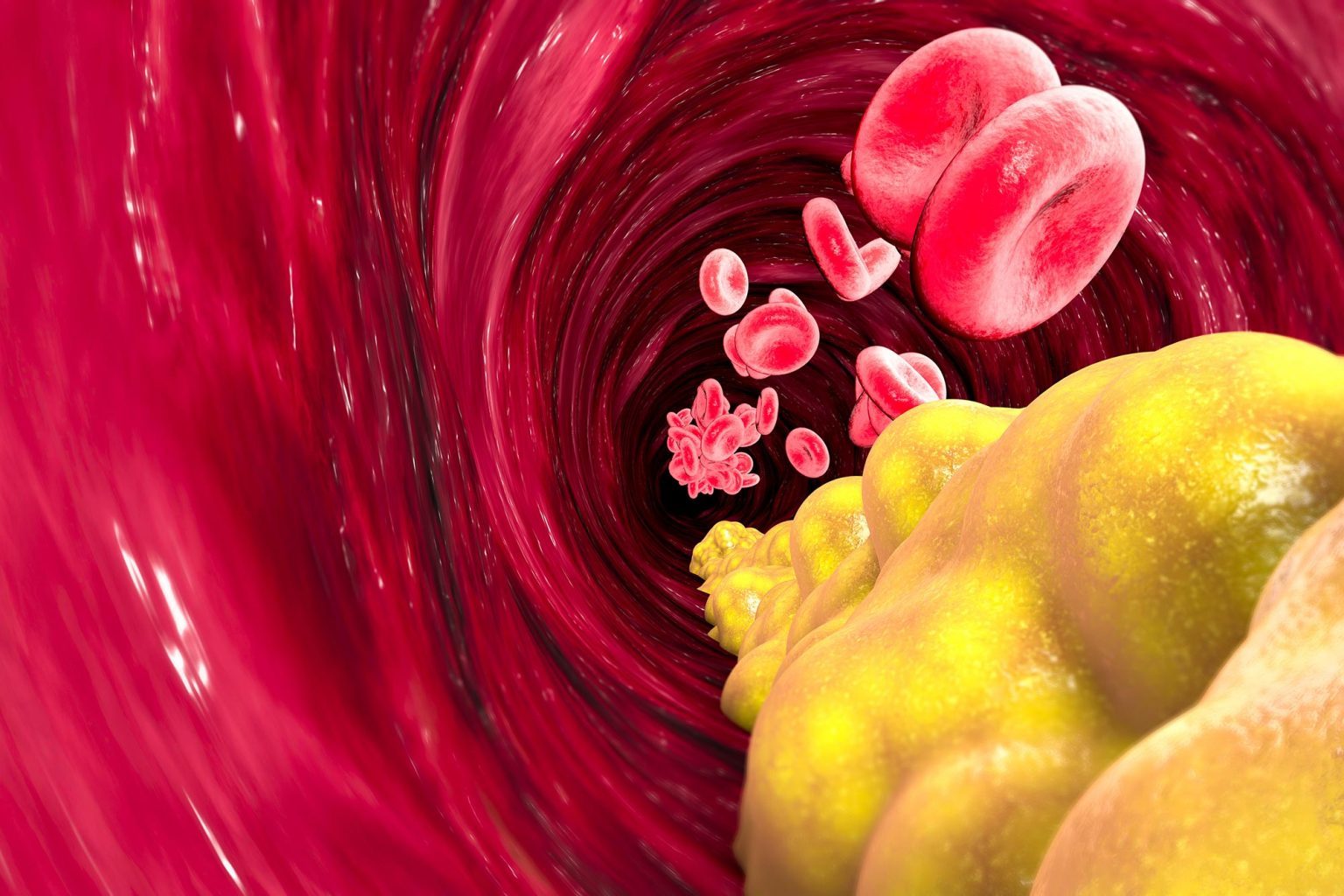 cholesterol arteries graphic