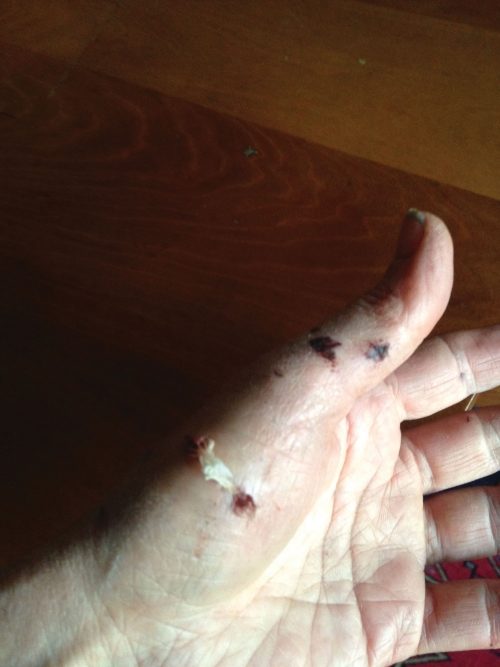 MERYL SIEGMAN’S HANDS show some of the puncture wounds she suffered while shielding her puppy from an attack by bear-hunting hounds in the Green Mountain National Forest near the Ripton-Goshen border earlier this month.