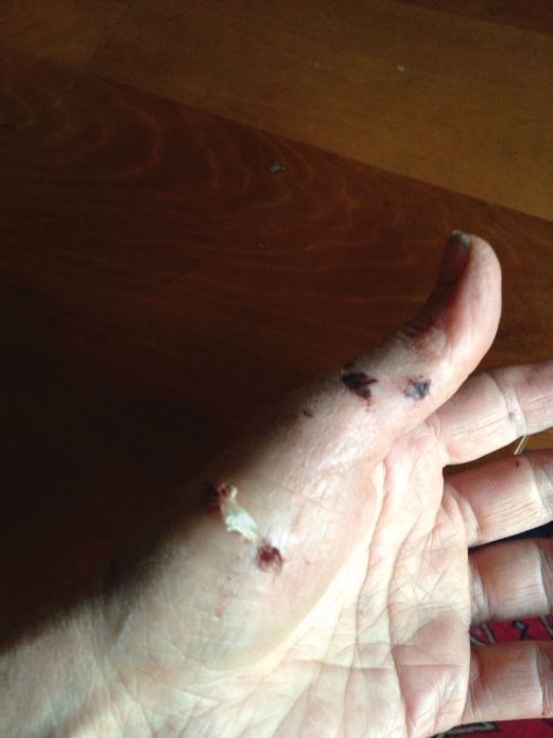 Click to enlarge MERYL SIEGMAN’S HANDS show some of the puncture wounds she suffered while shielding her puppy from an attack by bear-hunting hounds in the Green Mountain National Forest near the Ripton-Goshen border earlier this month.
