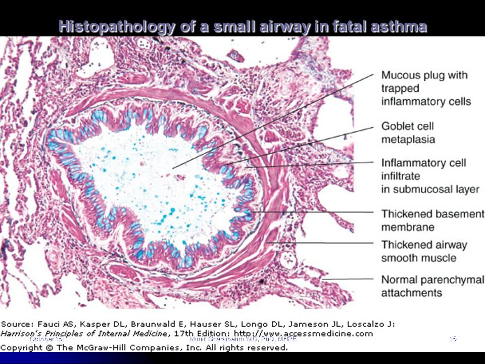 asthma