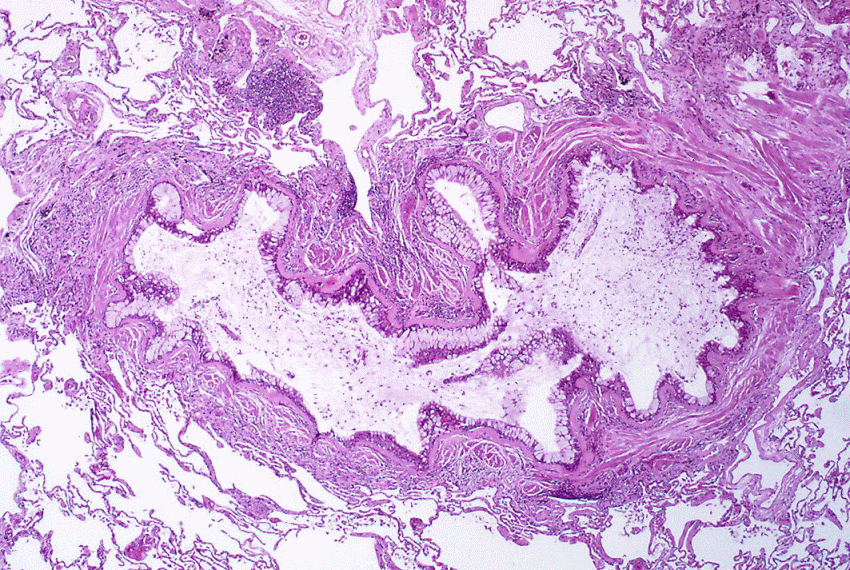 metaplasia