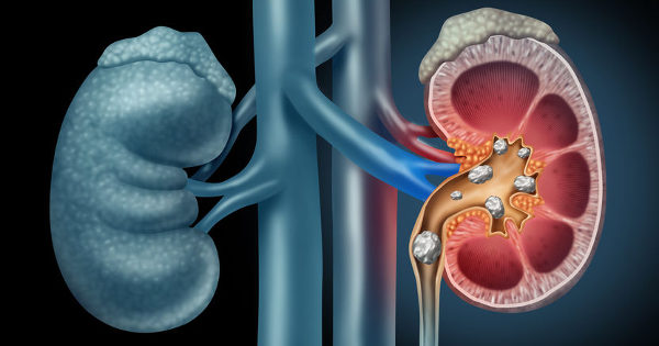 kidney stones black seed