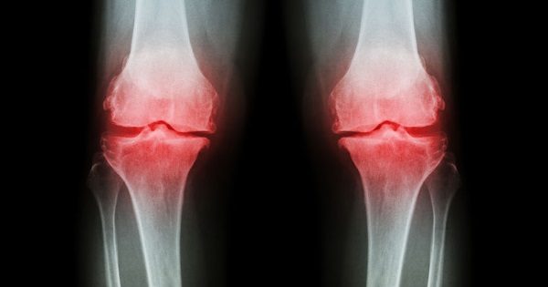 Osteoarthritis