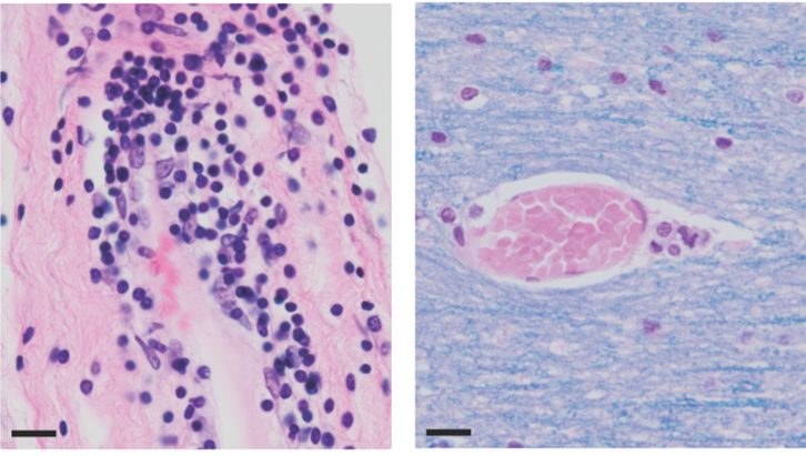 lymphocytes