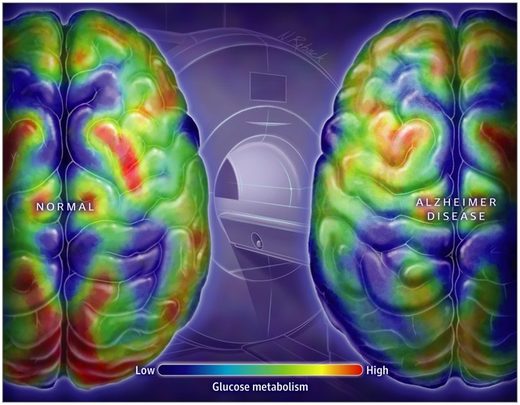 glucose metabolism brains alzheimers