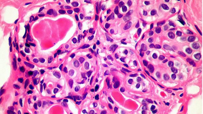 Click to enlarge Breast cancer cells
