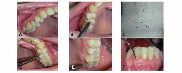Gums growing hair