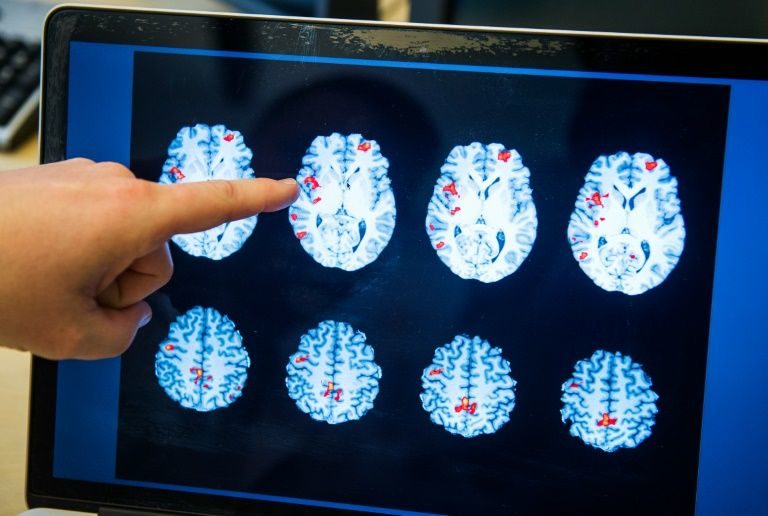 Click to enlarge Brain Scan