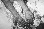 smallpox russia USSR