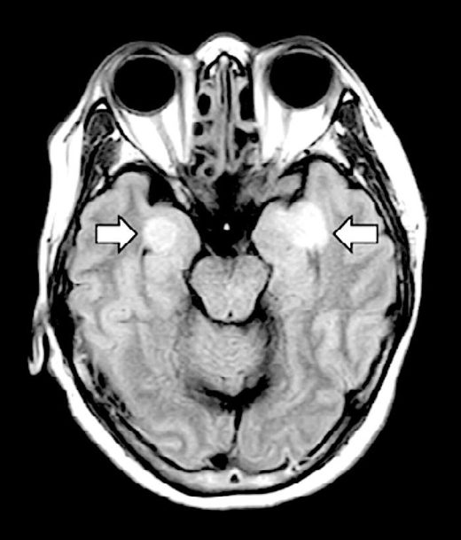 brain scan