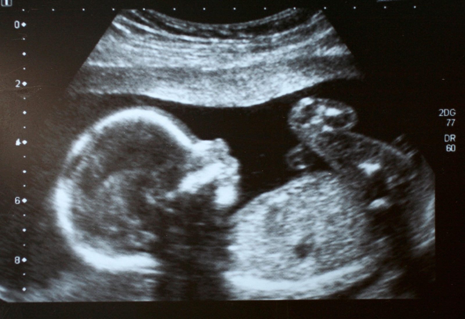 Click to enlarge Foetus in Womb