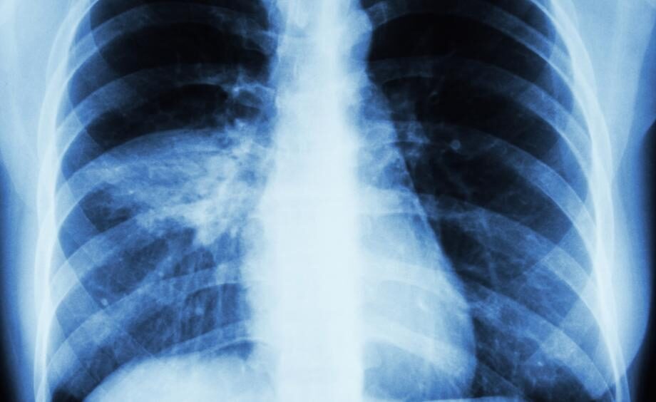 Click to enlarge pneumonia