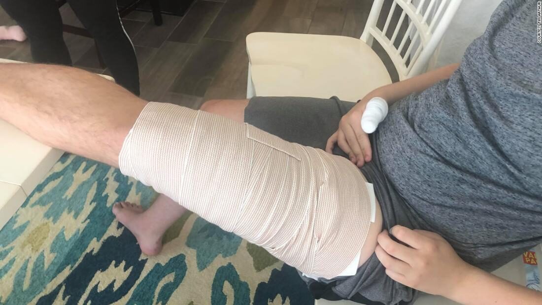 Click to enlarge Nick received 17 stitches and had 40 teeth prints on his thigh.