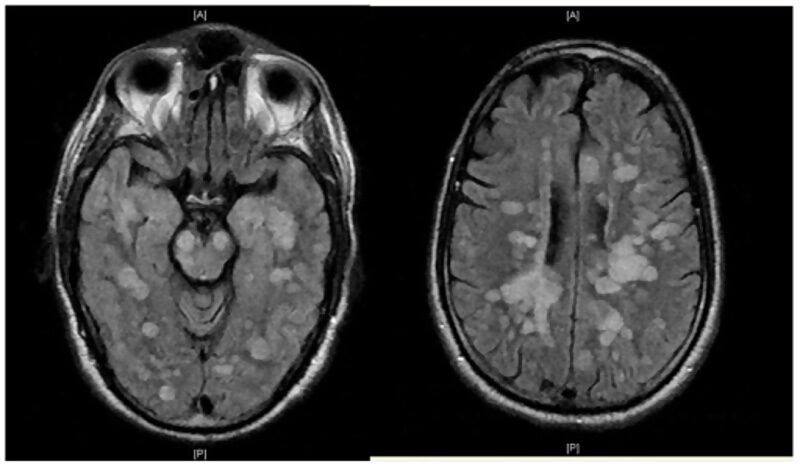 Click to enlarge Fulminating ADEM showing many lesions.