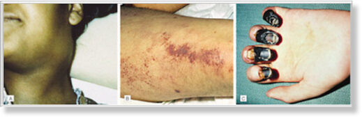 Click to enlarge Plague