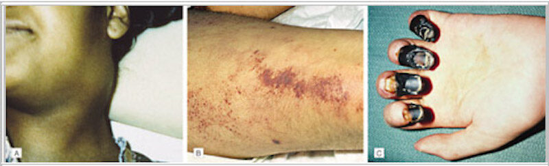 Click to enlarge Plague
