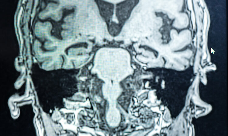 MRI scan