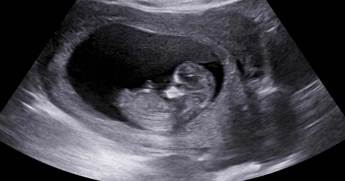 fetus