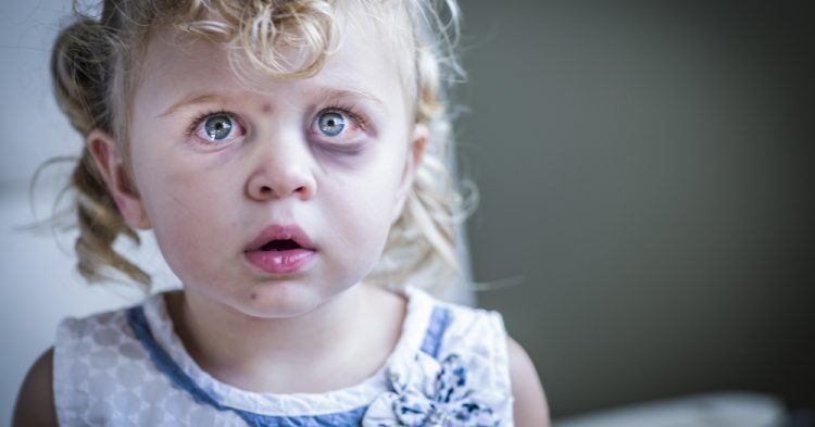 child black eye