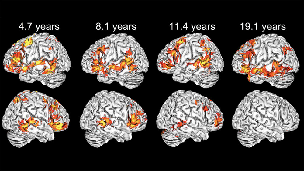 Brain Scans