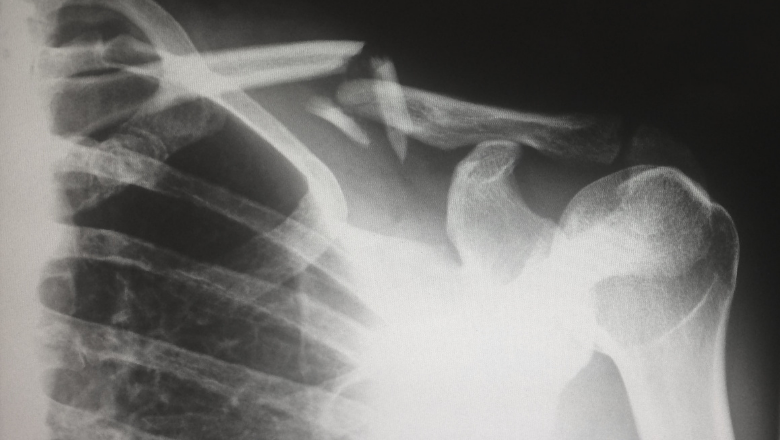 Broken Bones