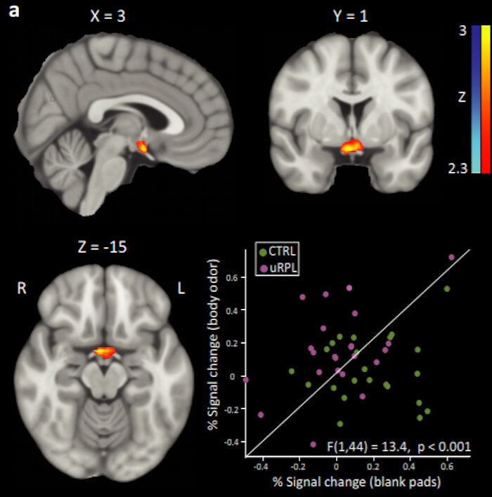 Click to enlarge fMRI of Hypothalamus