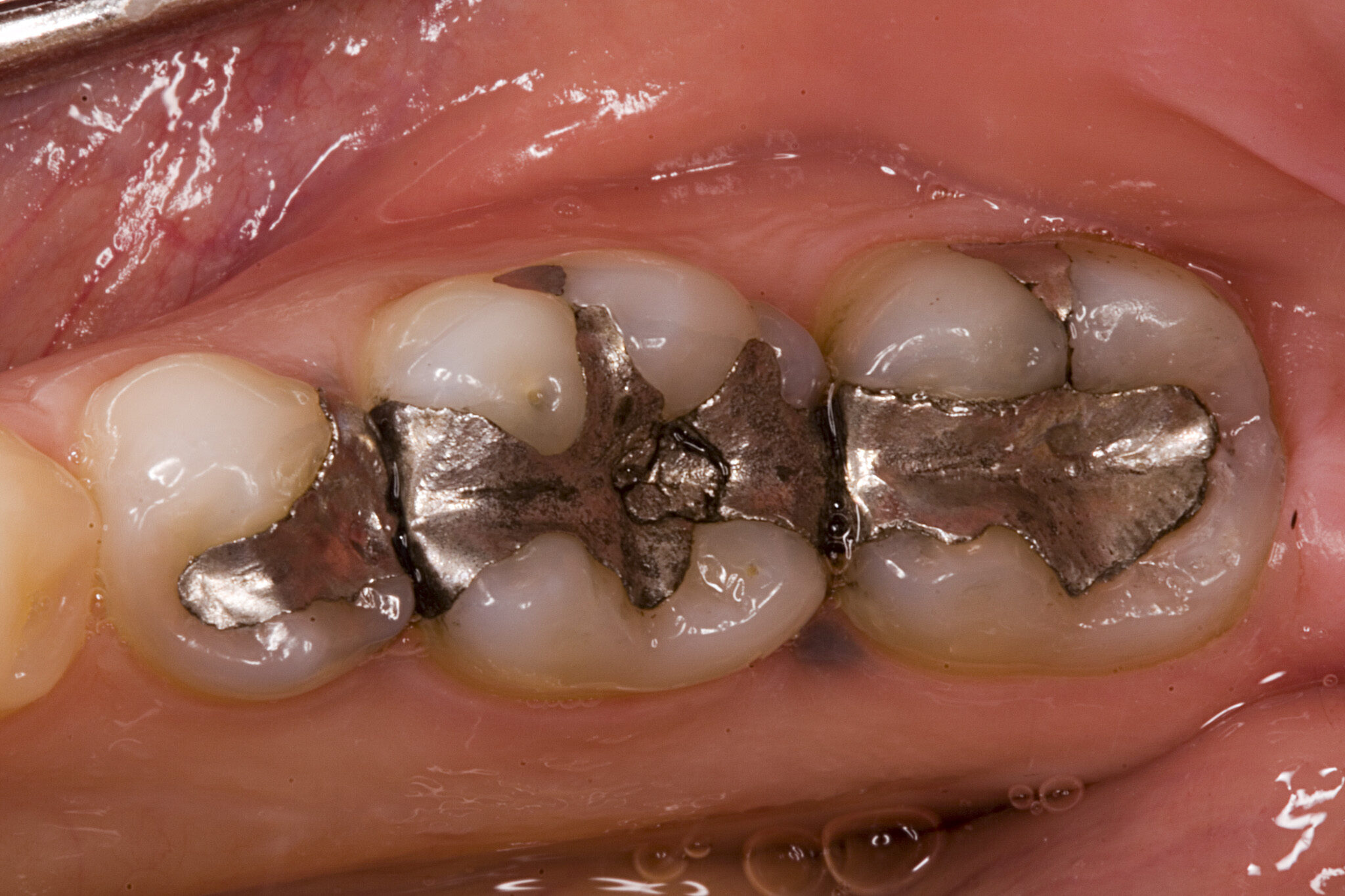 mercury amalgam fillings teeth