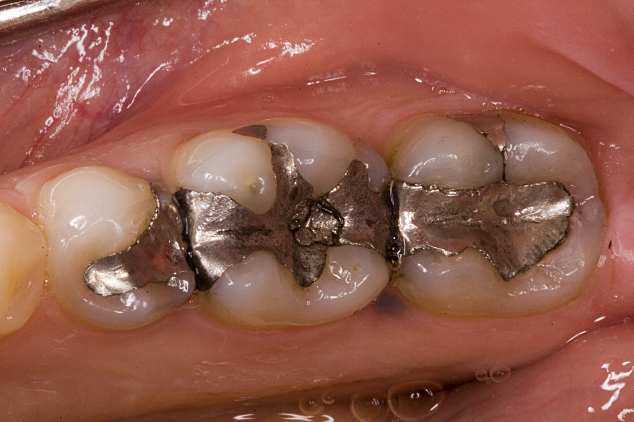 Click to enlarge mercury amalgam fillings teeth