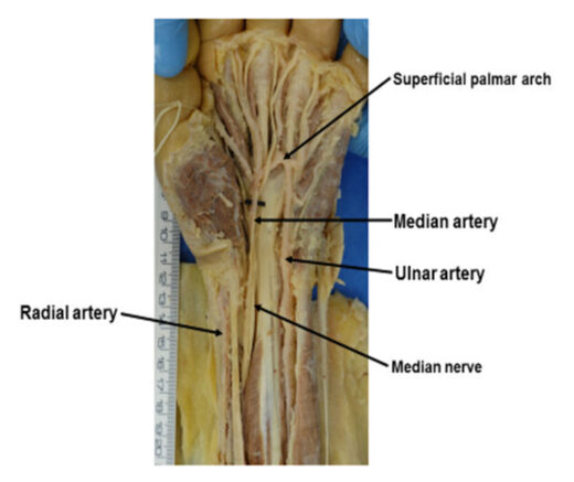 Click to enlarge Median Artery