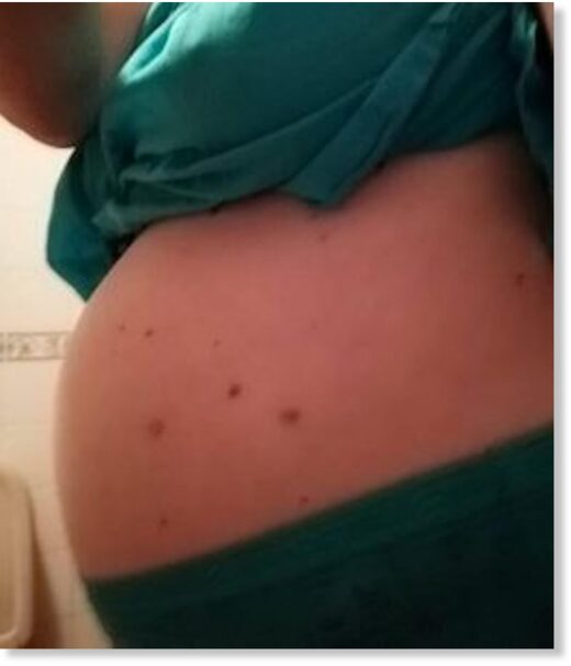 Click to enlarge The swollen abdomen of the patient after being treated with Harvoni