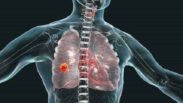 Lung cancer