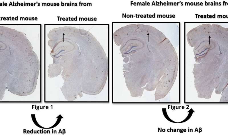Click to enlarge Alzheimer