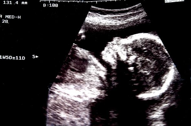 Sonogram baby
