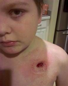 Standing wound