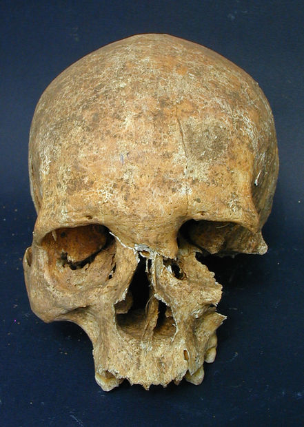 Click to enlarge Warrior Leprosy Middle Age
