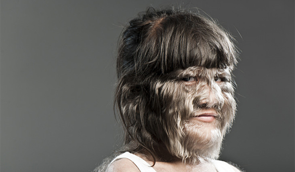 Hairiest Child