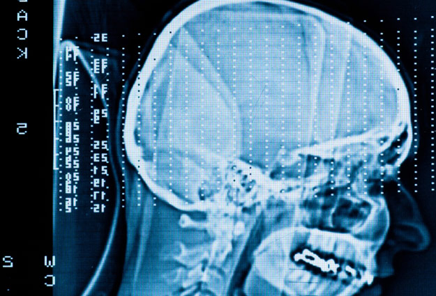 Click to enlarge CT Brain Scan