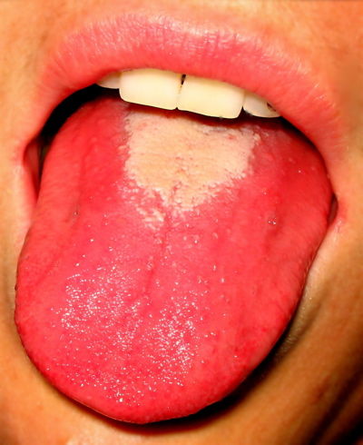Click to enlarge Scarlet fever