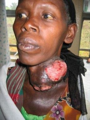 thyroid cancer tumor