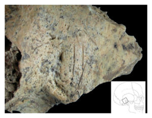 Click to enlarge Cut Marks on Human Bone