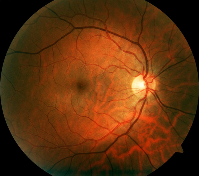 Retina