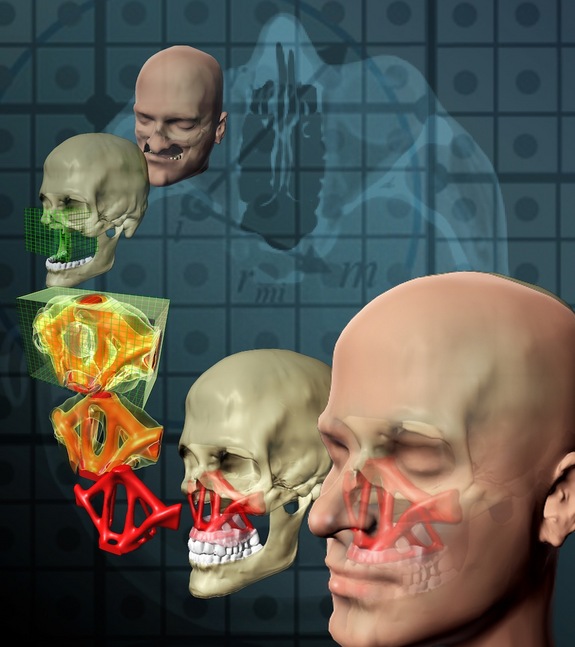 Facial Reconstruction